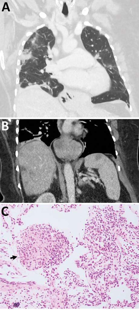 CT scans showing lung and organ abnormalities in 64-year-old woman with Ophidascaris robertsi nematode infection